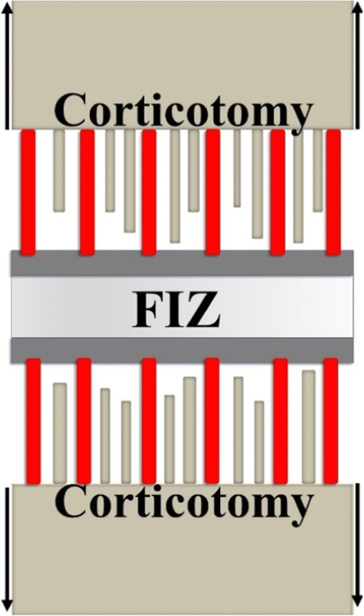 External fixators looking beyond the hardware maze skeletal radiology