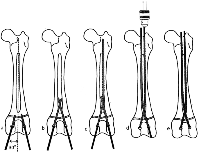 Principles of fracture fixation techniques