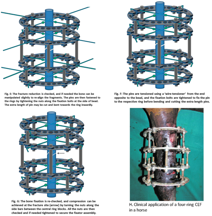Principles of fracture fixation techniques