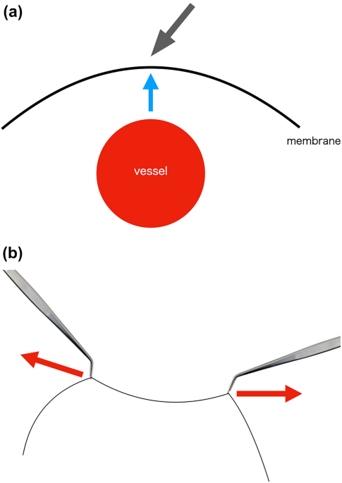Advances and safe use of energy devices in lung cancer surgery general thoracic and cardiovascular surgery