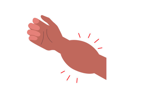 Un brazo hinchado lo que necesita saber sobre la hinchazãn de un brazo