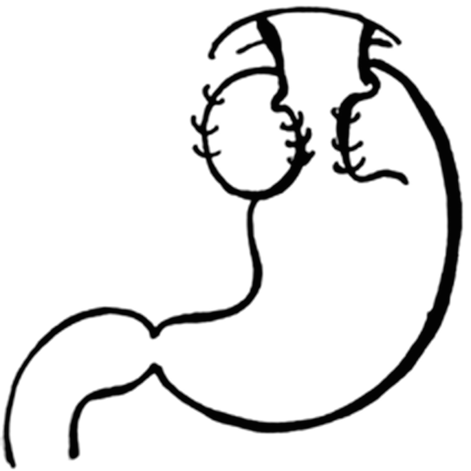 Surgery in motility disorders