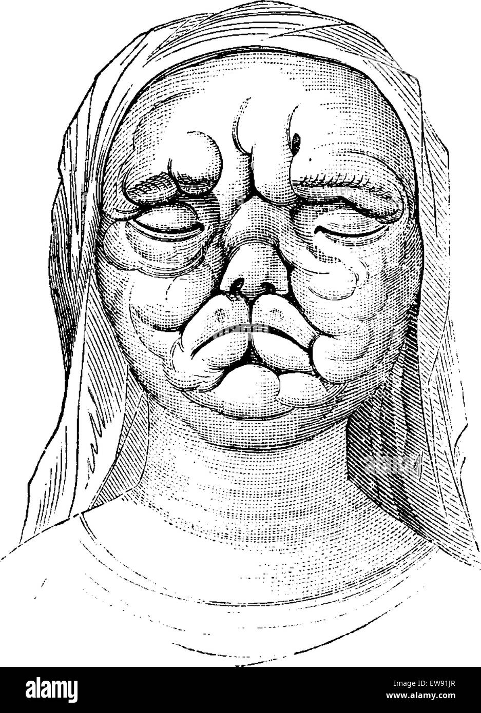 Leprosy black and white stock photos images
