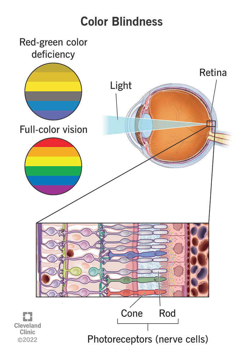 Color blindness types causes treatment
