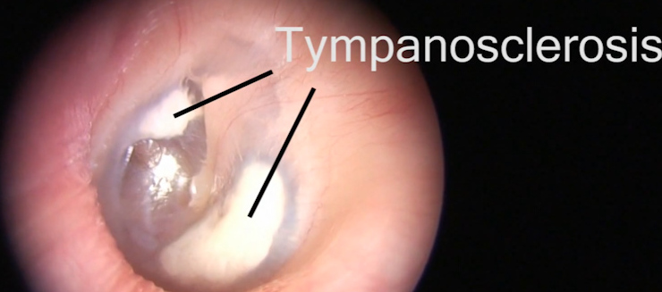 Tympanosclerosis