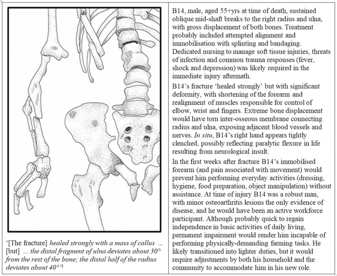 Helping to shine light on the dark ages applying the bioarchaeology of care approach to remains from the early anglo