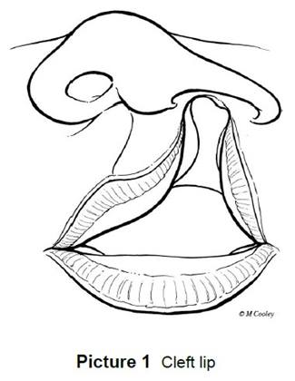 Cleft lip adhesion