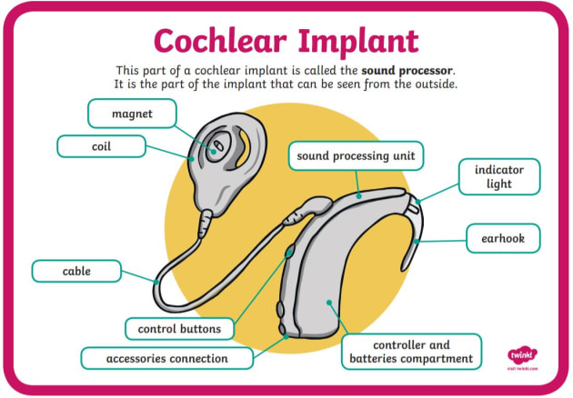 What is a cochlear implant