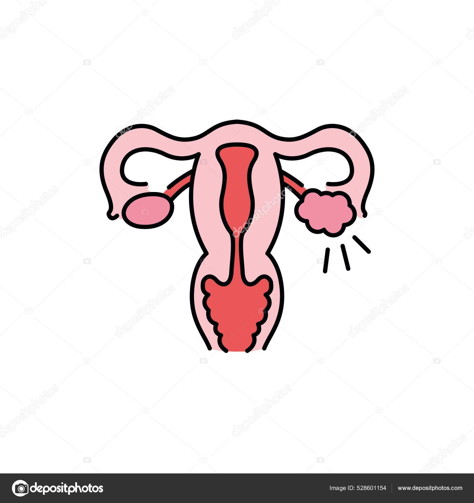 Polycystic ovary syndrome line color icon female reproductive system disease stock vector by alx