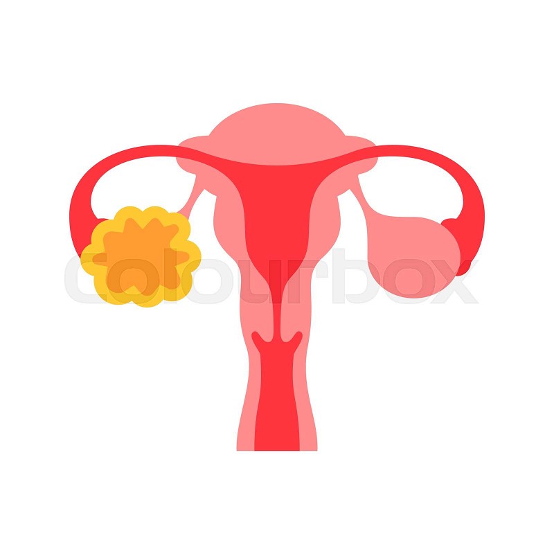Polycystic ovary syndrome flat color icon female reproductive system disease sign for web page mobile app button logo vector isolated element stock vector