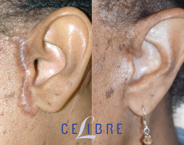 Scar removal before and after pictures