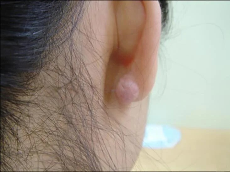 Keloid on ear causes treatment and prevention