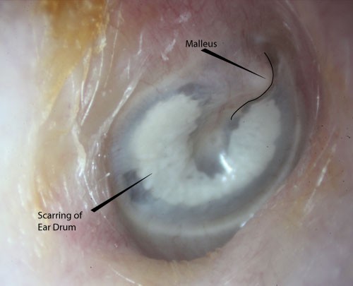 Tympanosclerosis mcgovern ical school