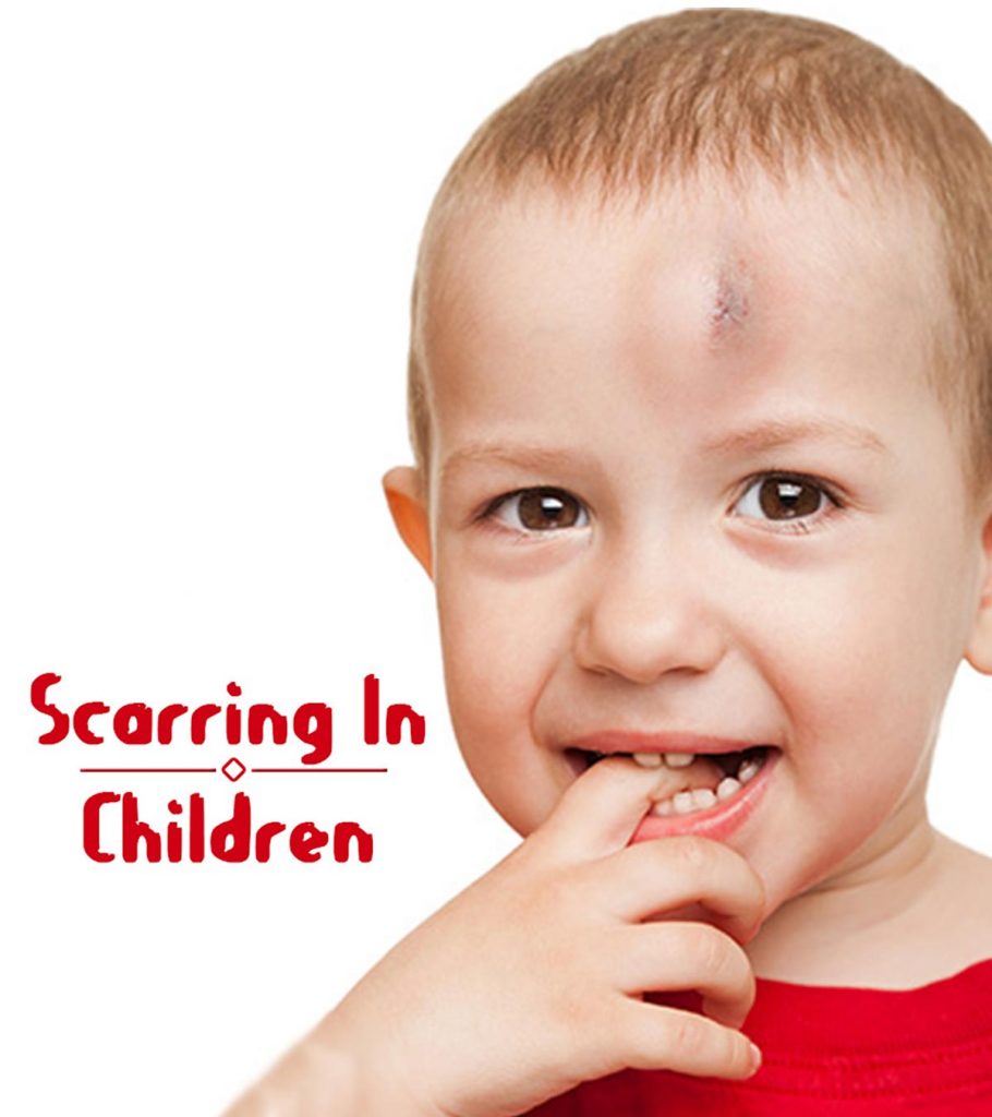 Simple ways to treat kids scars and prevention tips