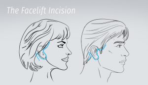 An overview of facelift incision lines and scars