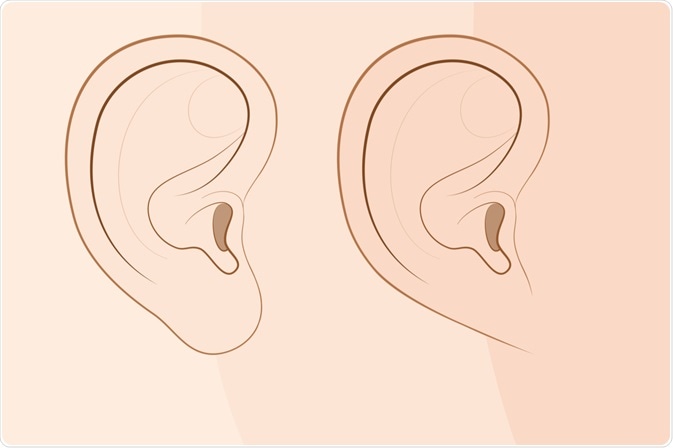 Geics of earlobes